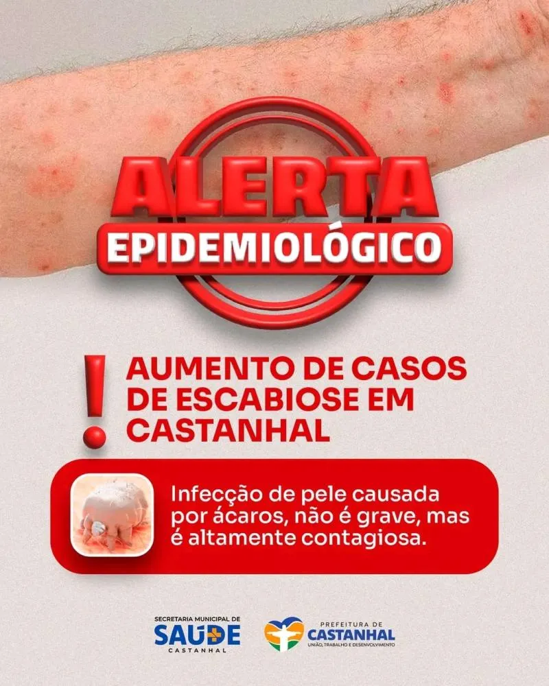 Vigilância Epidemiológica de Castanhal emite alerta para aumento dos casos de escabiose